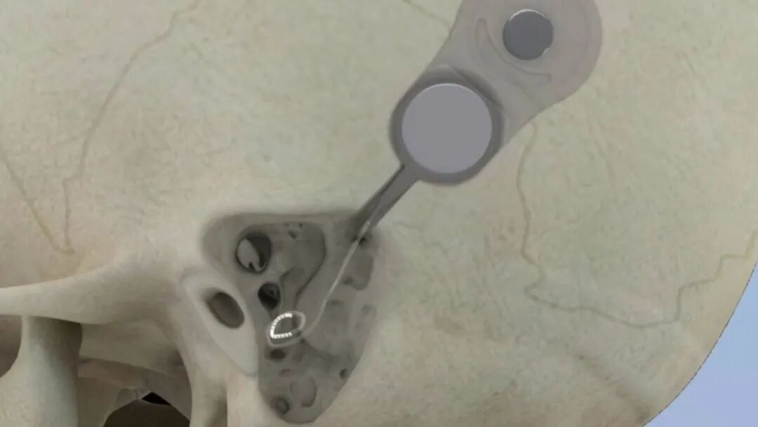 好消息！本月起，纳入医保！